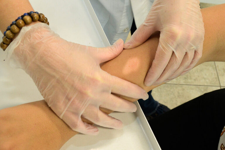 Estado registrou mais de 2 mil casos de hanseníase em 2022